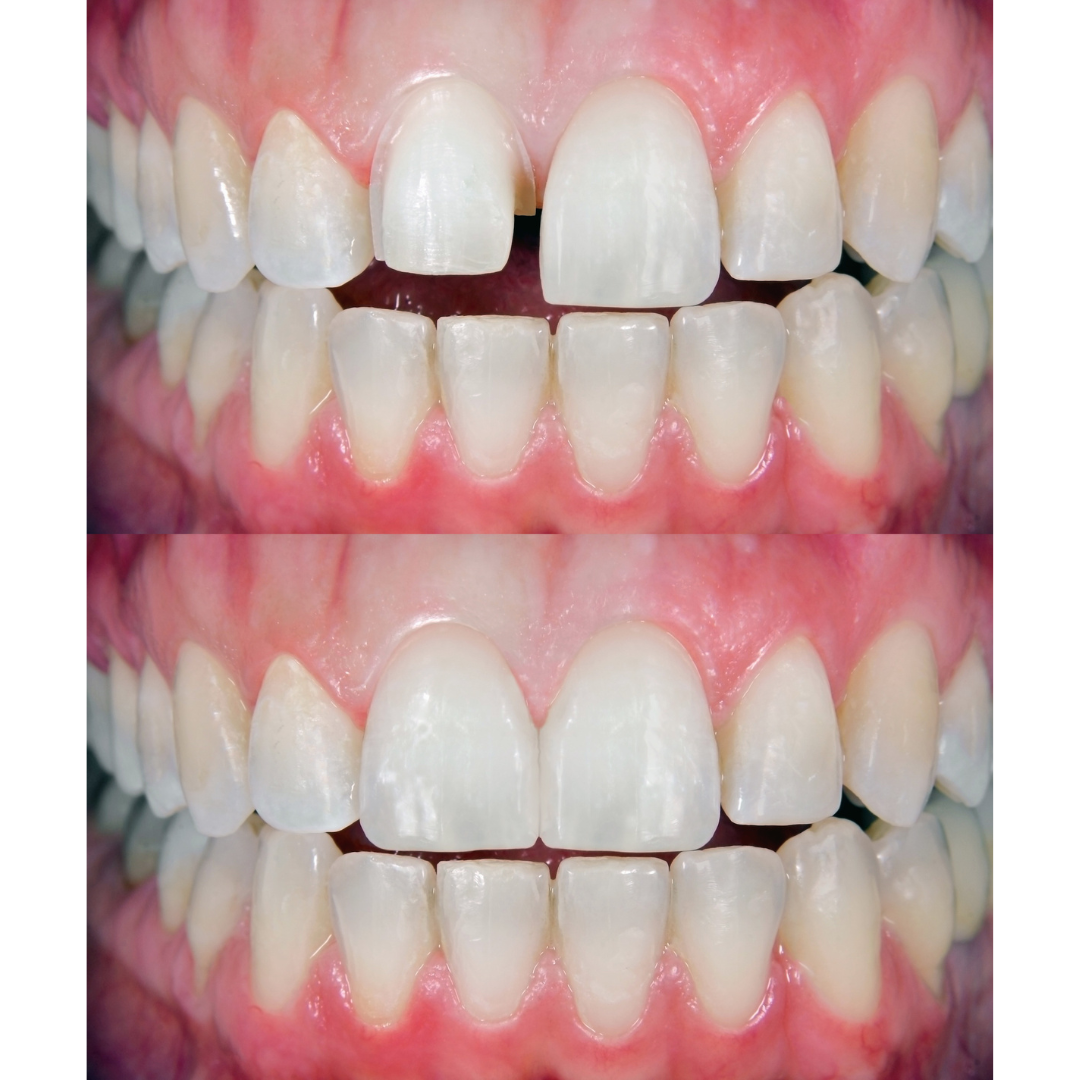 Veneers Specialist